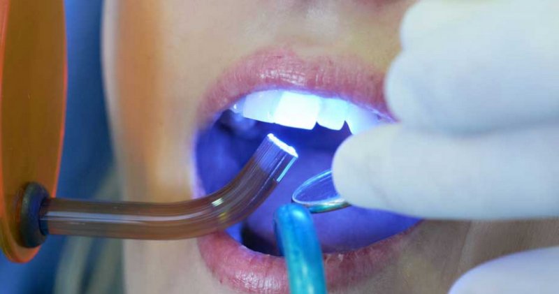 sbiancamento-denti-con-il-laser