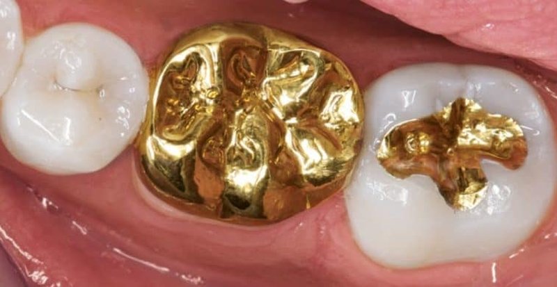dente-doro-otturazione-con-oro