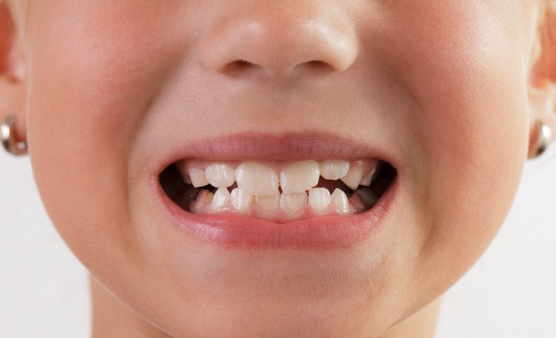 denti-e-carenza-vitamina-d-nei-bambini