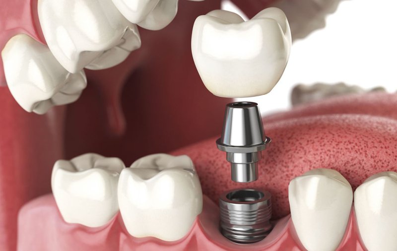implantologia-dentale-come-funziona