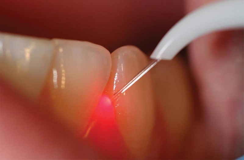 parodontite-terapie-laser