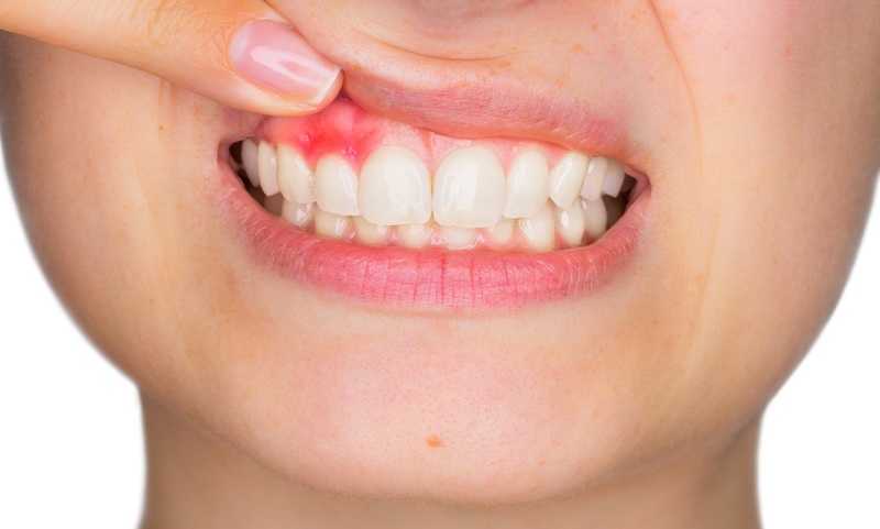 acido-ialuronico-e-denti