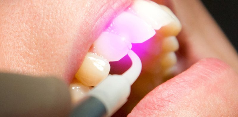 parodontite-intervento-laser