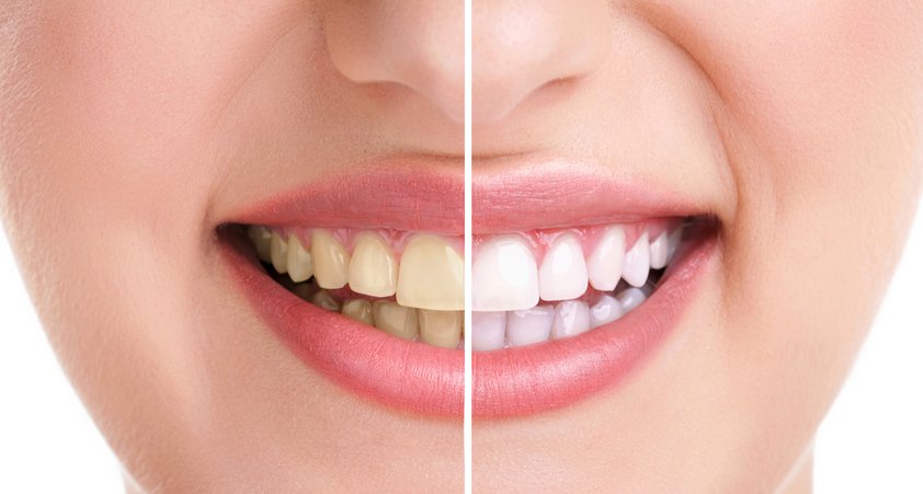 dentifricio-al-carbone-attivo-denti-bianchi