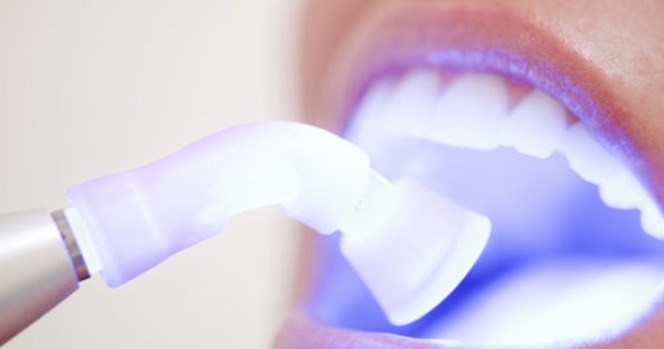 sbiancamento-denti-laser