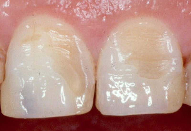 smalto-dentale-danneggiato